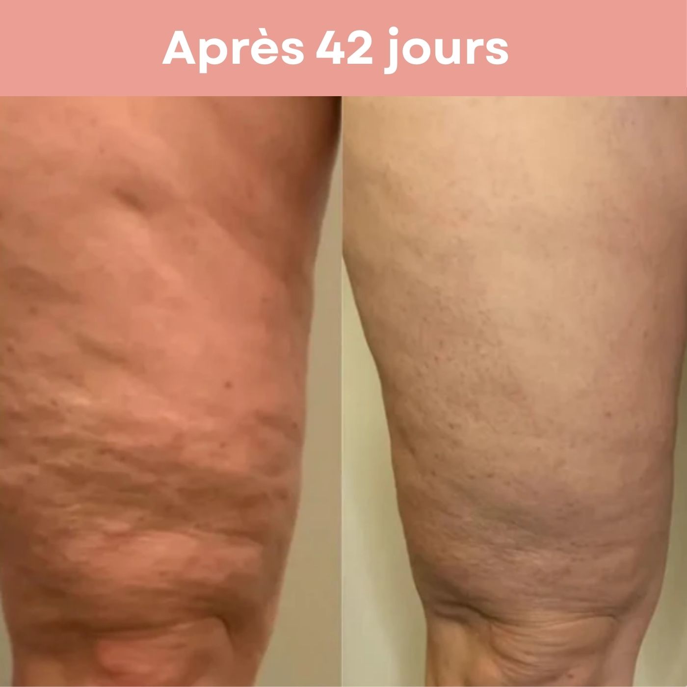 Appareil de Massage Anti-Cellulite BEAUTIFERA 3 en 1 - Beautifera